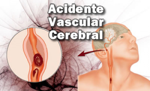 A Organização Mundial de AVC estima que uma em cada seis pessoas no mundo terá um acidente vascular cerebral na vida