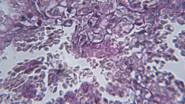 Imagem microscópica de uma infecção secundária por aids (Duncan Smith / Thinkstock)