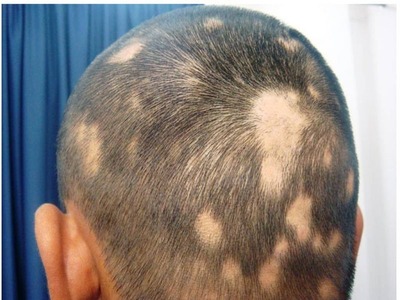 Placas circunscritas de perda de cabelo são observadas na alopecia areata.
